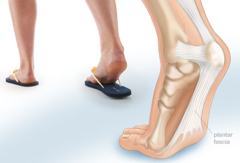 Help for Plantar Fasciitis